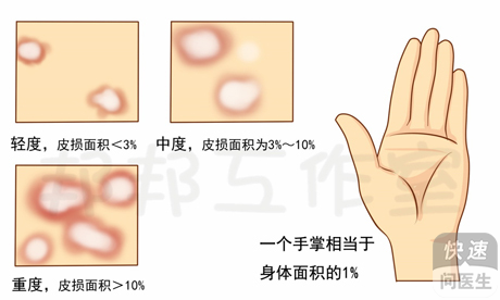 銀屑病怎樣治療？科學(xué)用藥是關(guān)鍵