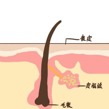 閉合性粉刺怎么治療？這招得知道