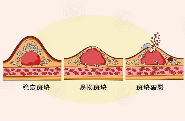 寒潮來襲時(shí)，別讓心腦血管病找上門