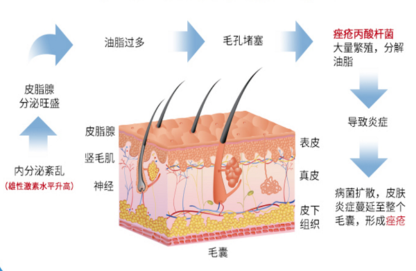 祛痘用毛巾熱敷好還是冷敷？哪種方式都不如這個藥膏管用