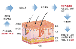 痤瘡一般能什么時候好？這點做到恢復(fù)快