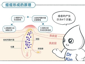 祛痘方法：額頭上發(fā)炎長痘痘用什么藥膏？