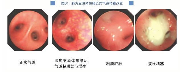 支原體會“襲”肺 流感也會“犯”肺 哪個不妨都不行