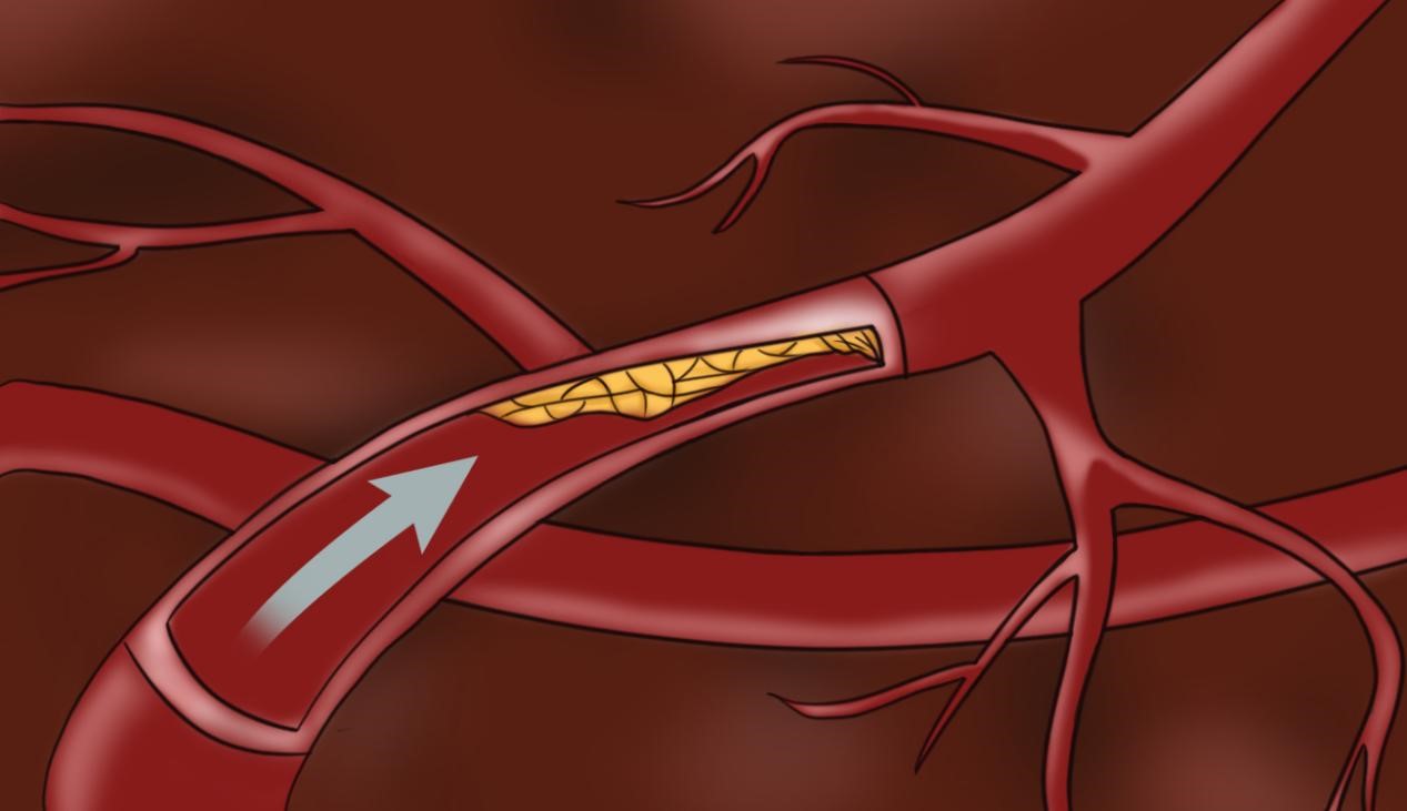健康科普：頸動(dòng)脈斑塊怎么形成的