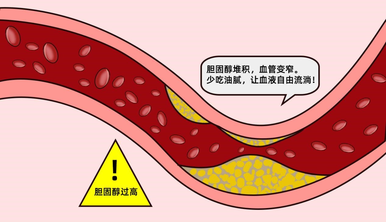 頸動(dòng)脈斑塊會(huì)引起哪些癥狀