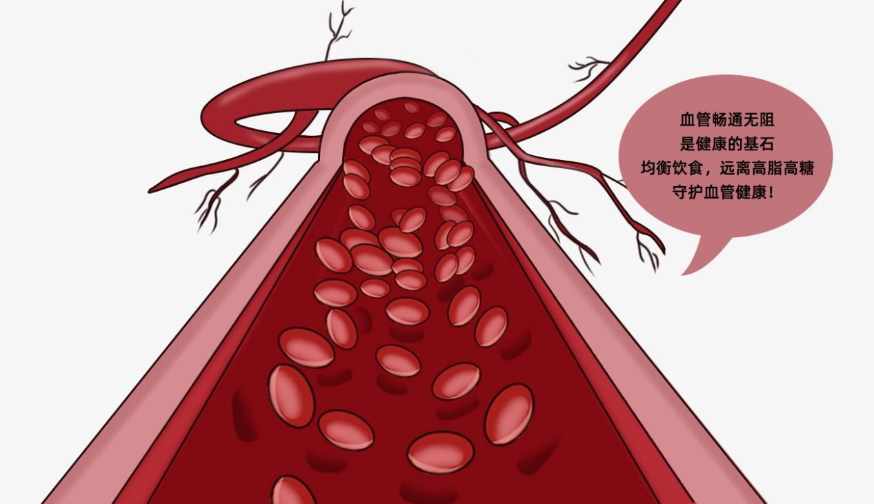 頸動(dòng)脈斑塊是怎樣形成的