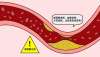 頸動脈硬化斑塊怎么辦